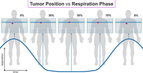 A Standardized Workflow For Respiratory‐gated Motion Management