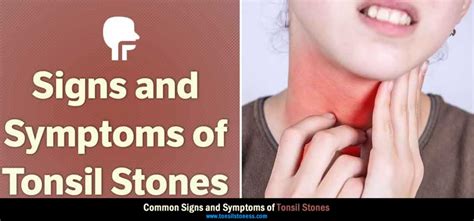 Tonsil Stones Symptoms - 9 Common Symptoms of Tonsil Stones