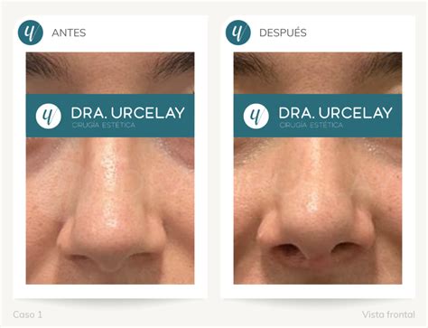 Rinoplastia Ultrasónica Qué Es Beneficios Y Ventajas