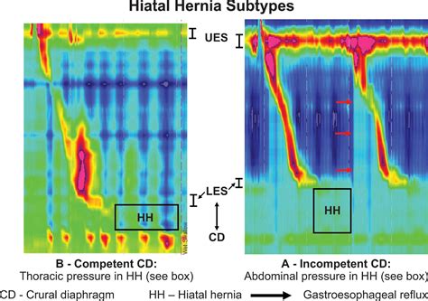 A Primer Of High Resolution Esophageal Manometry Seminars In Thoracic