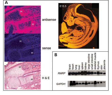 Cartilage Hair Hypoplasia Semantic Scholar