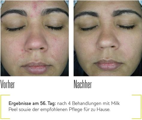 Chemisches Peeling Dr Pavicic Hautarzt München