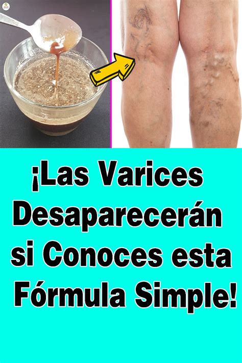 Pin En Remedio Para Las Varices