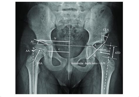 Definitions Of The Radiographical Measurements Of The Morphology Of