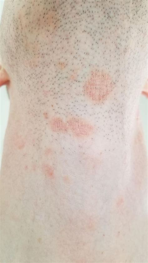 Ringworm On Back Of Neck