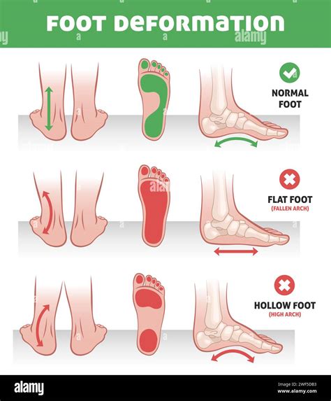 Foot Deformation Feet Pathology Infographics Normal Position Flat And Hollow Feet Arch Of