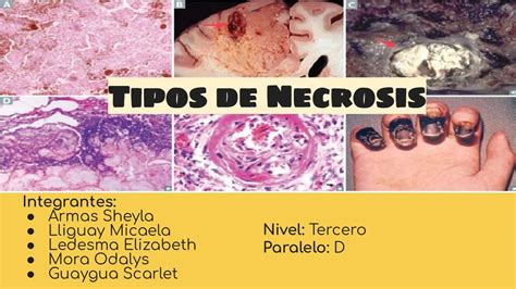 Tipos De Necrosis Imed Udocz