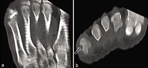 Subchondral Osteoid Osteoma Of A Metatarsal Bone An Uncommon Variant