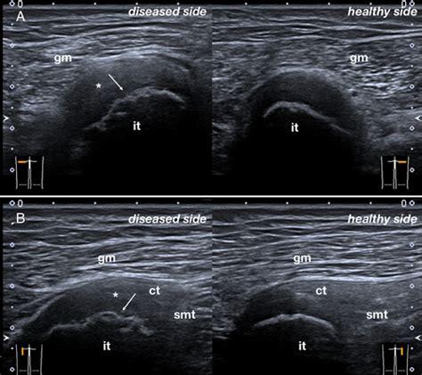 Proximal Hamstring Ultrasound