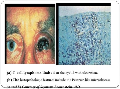 Ocular Lymphoma