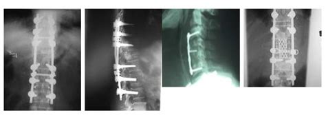 Spinal Instrumentation Dr Arun Oommen