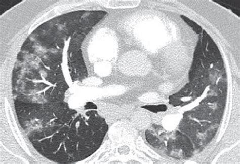 -Diffuse pulmonary hemorrhage occurring in a 42 y.o. male patient with... | Download Scientific ...