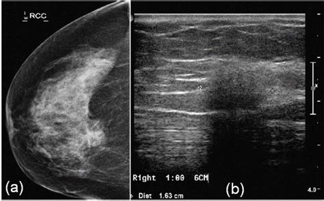 A X Ray Mammography Cranio Caudal View And B Ultrasound Image Of