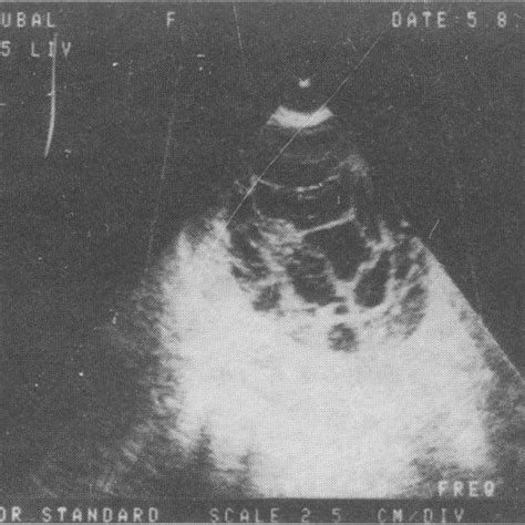 Case 2 Ultrasonic Echogram Using B Mode Sector Scan Showing A Well