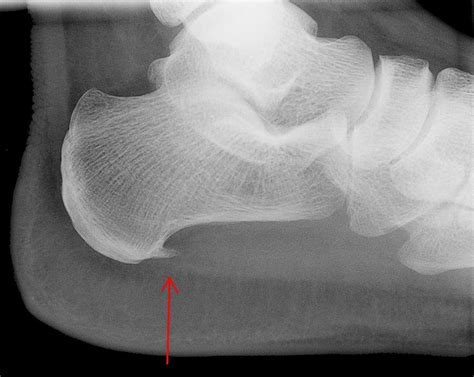 Bone Spur Causes Symptoms And Possible Treatments HealDove