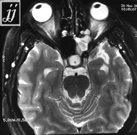 Sphenoidal Sinus Retention Cyst Radiopaedia