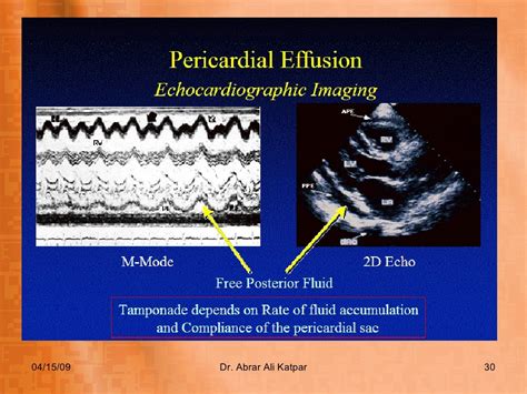 Uremic Pericarditis