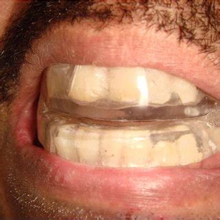 Mandibular Advancement Splint MAS Example Of A Customized Two Piece