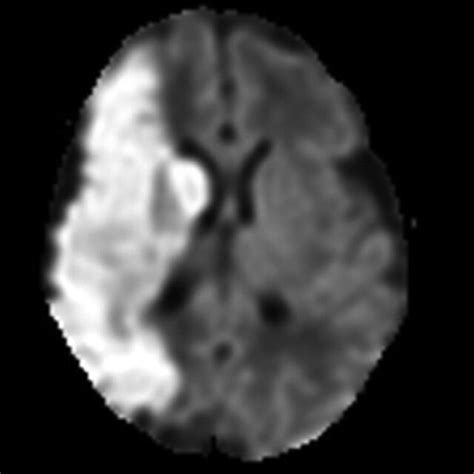 Head Mri Dwi Sequence Ischemia In The Right Mca Territory Mri