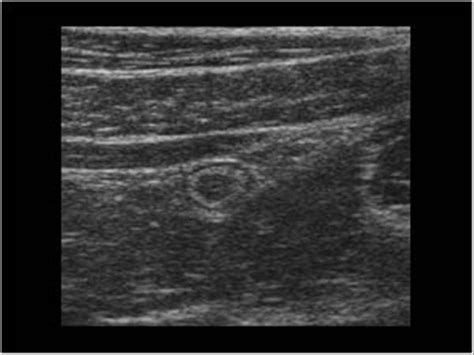 Abdomen And Retroperitoneum 1 5 Appendix Case 1 5 1 Normal Appendix