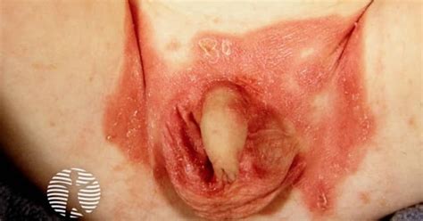 Genital Psoriasis Image