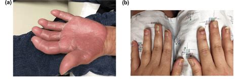 A Well Demarcated Palmar Erythema And Edema Consistent With Hand Foot