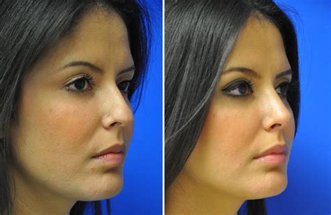 Rhinoplasty 13 Austin Tx Dr Weinfeld