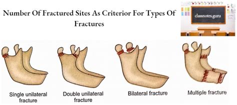 Mandible Osteology Anatomy Notes Class Notes