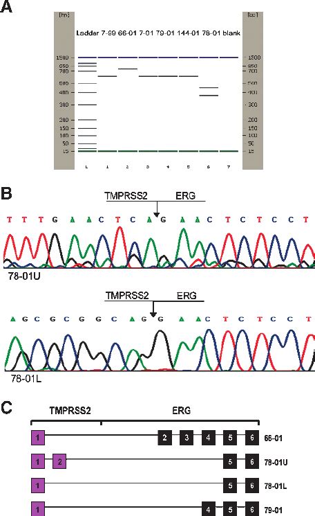 Rearrangement Of The Tmprss And Erg Genes In Pca A Rt Pcr Products