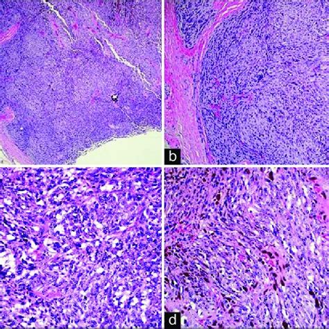 A Tumor Is Circumscribed With Cells In Fascicles And Nests B