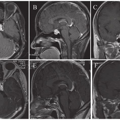 A Axial B Sagittal And C Coronal Pre Operative Post Contrast MRI