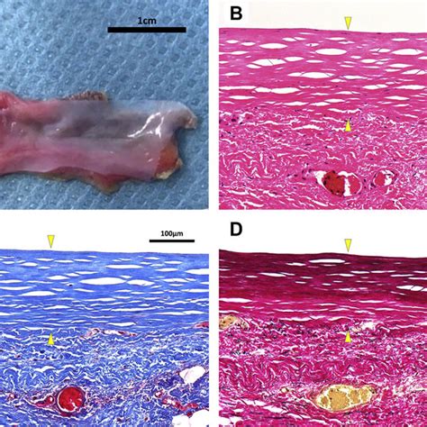 Specimens Of In Vivo Tissue Engineered Vascular Graft In Case 2 Before