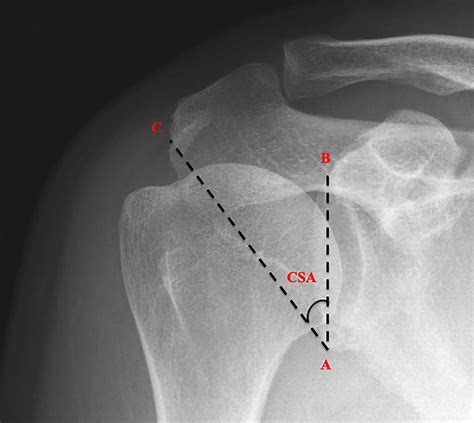 Critical Shoulder Angle Formed By A Line Joining The Inferior Point A