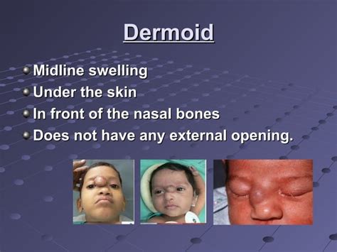 Diseases Of External Nose Ppt