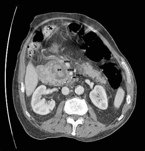 Figure 1 From A Rare Pancreatic Pseudoaneurysm In Patient With Acute