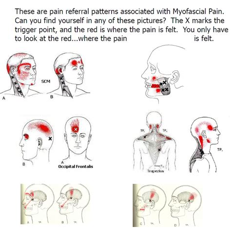 Headache Neck Pain Treatment Dr Jim Ney Dmd Faaop Central Ky