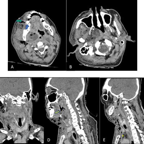 Pdf Ludwigs Angina An Alarming Radiology Challenge