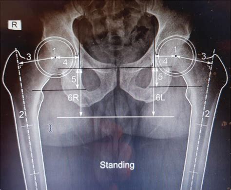 Preoperative Planning Of Total Hip Arthroplasty Intechopen