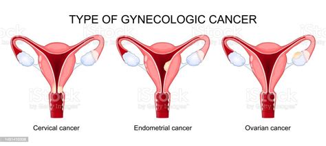 Type Of Gynecologic Cancer Ovarian Endometrial And Cervical Cancer