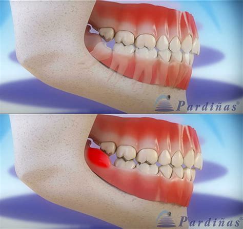 Infecci N De Muela S Ntomas Y Tratamientos Para Eliminarla Gaceta Dental