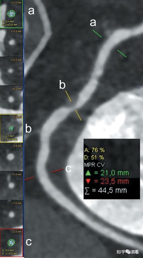 冠状动脉cta：如何进行检查和图像解释及临床适应症指南 知乎