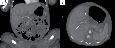 Angiotomograf A De Abdomen A Corte Coronal La Flecha Muestra La