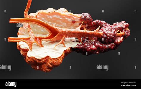 Malattia Pancreatica Ghiandola Digestiva Diagramma Anatomico Del