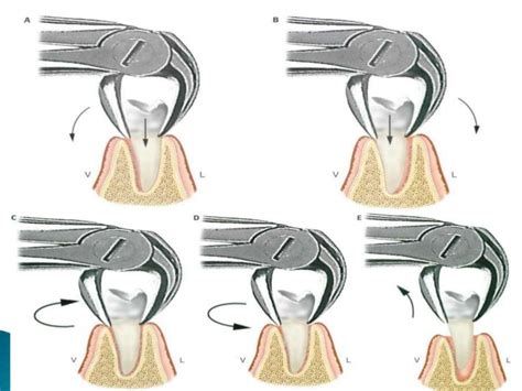 T Cnicas De Exodoncia En Maxilar Y Mand Bula Dental Extraction Dental