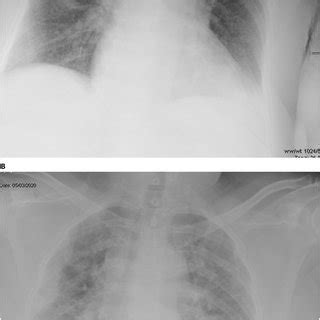 A Portable Anterior Posterior Chest Radiograph Showing Bilateral