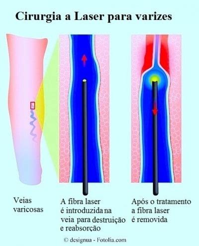 Veias Varicosas Nas Pernas Sintomas Tratamento E Cirurgia A Laser