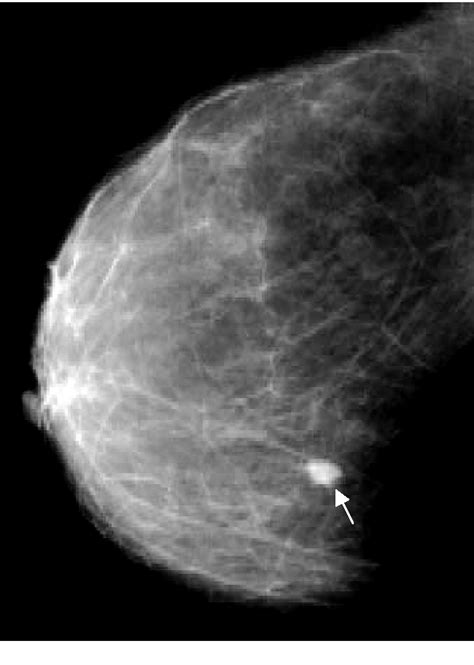 Figure 1 From A Comparison Of Mammography And Ultrasonography In The