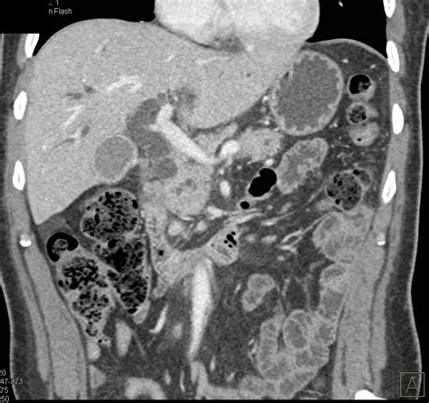 Pancreatic Adenocarcinoma With Arterial Encasement And Pancreatic Duct Dilatation Pancreas