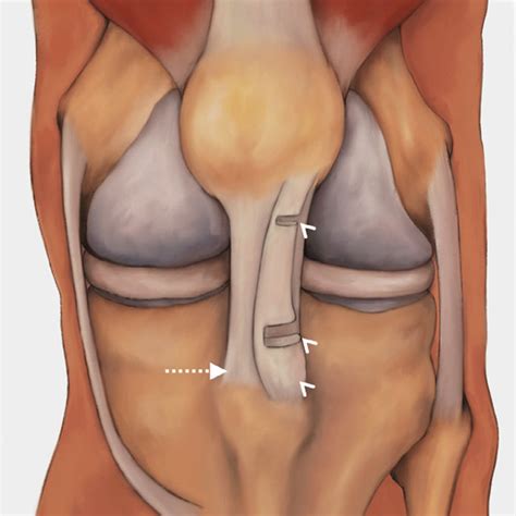 Schematic Illustration Of The Uncrossed Doubled Patellar Tendon Of Download Scientific