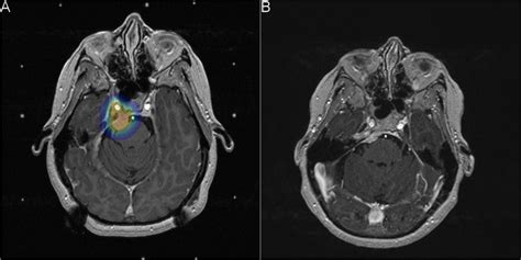 A Procedural Axial T1 Weighted Contrast Enhanced Brain MRI With